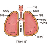 늑막염