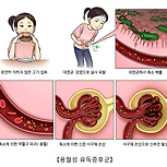 용혈성 요독 증후군