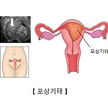 포상기태