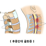 후종인대 골화증