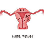 원발성 월경곤란