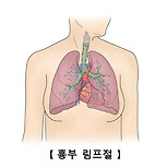 비호지킨 림프종