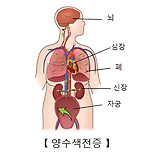 양수 색전증