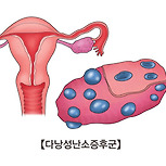 다낭성 난소증후군