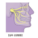 삼차 신경병증