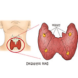 부갑상선기능항진증