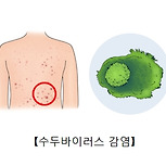 대상포진