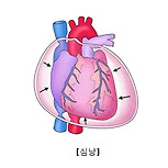 심낭염