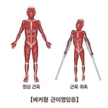 베커형 근이영양증