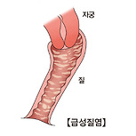 급성 질염