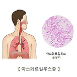 아스페르길루스증