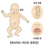 베크위트-위드만 증후군