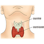 갑상선 여포암