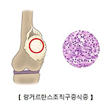 랑거한스세포 조직구증식증