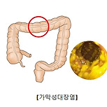 위막성 대장염