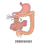 장염전