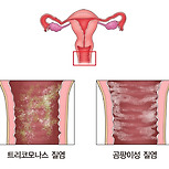 칸디다성 외음질염