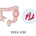 대장균 감염