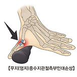 무지(엄지)중수지관절측부인대손상