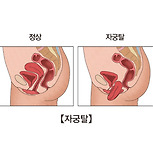 자궁 탈출증