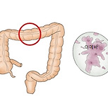 아메바성 이질