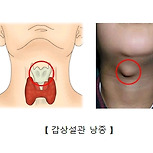 갑상설관 낭종