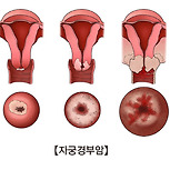 자궁경부암