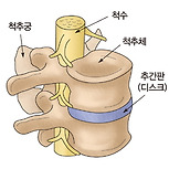 경추 추간판 탈출증