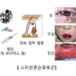 스티븐 존슨 증후군