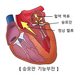 승모판 기능부전