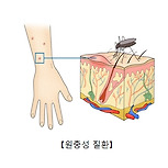 원충성 질환