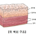 만성 위염