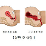 분만 후 출혈