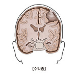 수막종