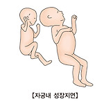 자궁 내 성장 지연