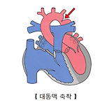 대동맥 협착증