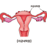 과다월경