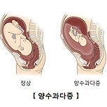 양수과다증