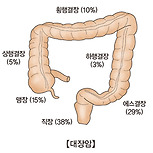 대장암