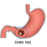 진행성 위암