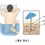 재생불량빈혈