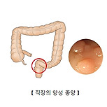 직장의 양성 종양