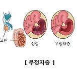 무정자증