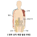 연부조직 육종