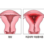 자궁내막 이상증식증