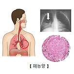 폐의 농양