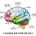 교모세포종