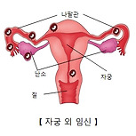 자궁외 임신