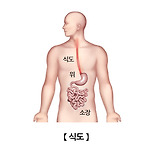 식도 정맥류