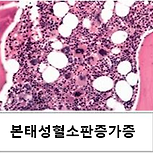 골수증식종양